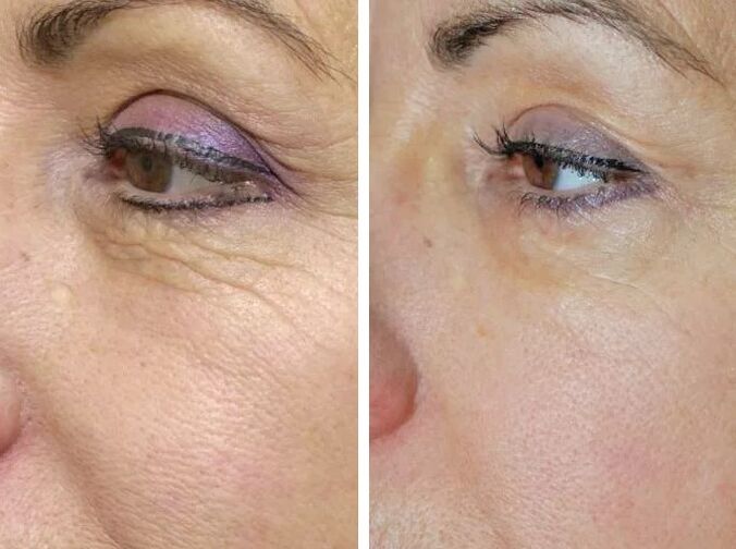 Laserfeld vor und nachher